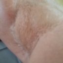 degloved rt arm Cindy.jpg