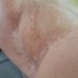 degloved rt arm Cindy.jpg