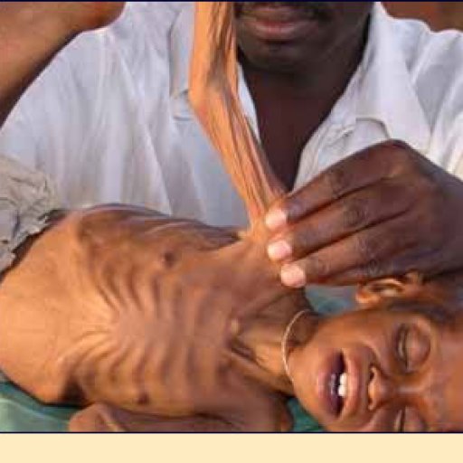 starvation_hunger