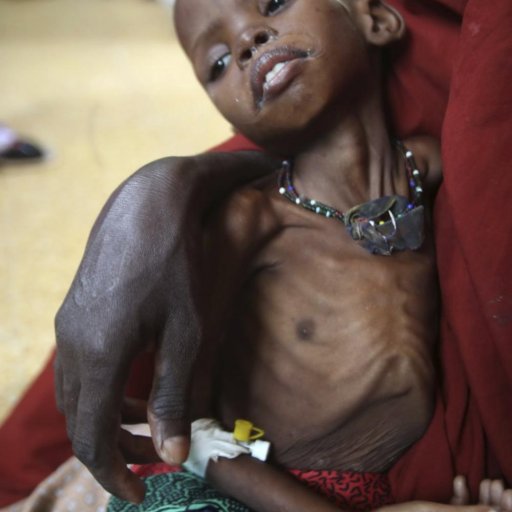 132838-millions-of-malnourished-children-in-horn-of-africa-are-at-risk-of-dyi