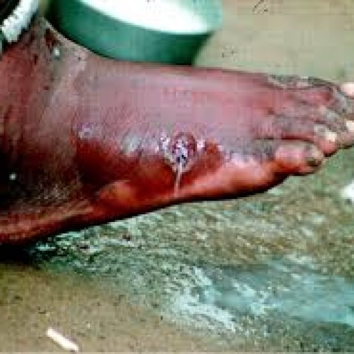 Guinea Worm