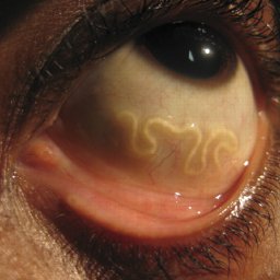 Loiasis-Worm.jpg