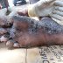 Jiggers