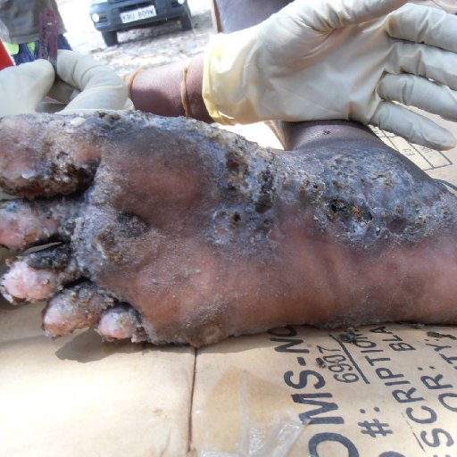 Jiggers