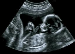 ultrasoundbabymotherswomb600nw546641992.jpg